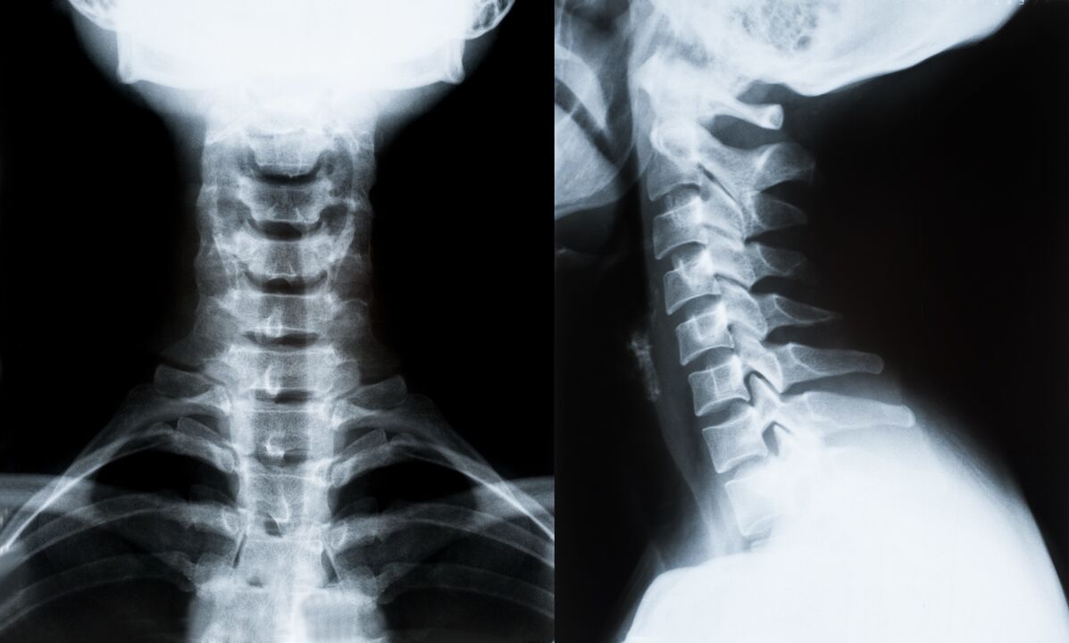 emakakaela osteokondroos röntgenpildil